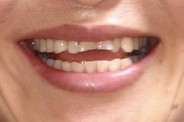 30代女性笑ったときに前歯が見えないのがコンプレックスで部分矯正で治療した症例 我孫子の歯医者さん｜なかむら歯科
