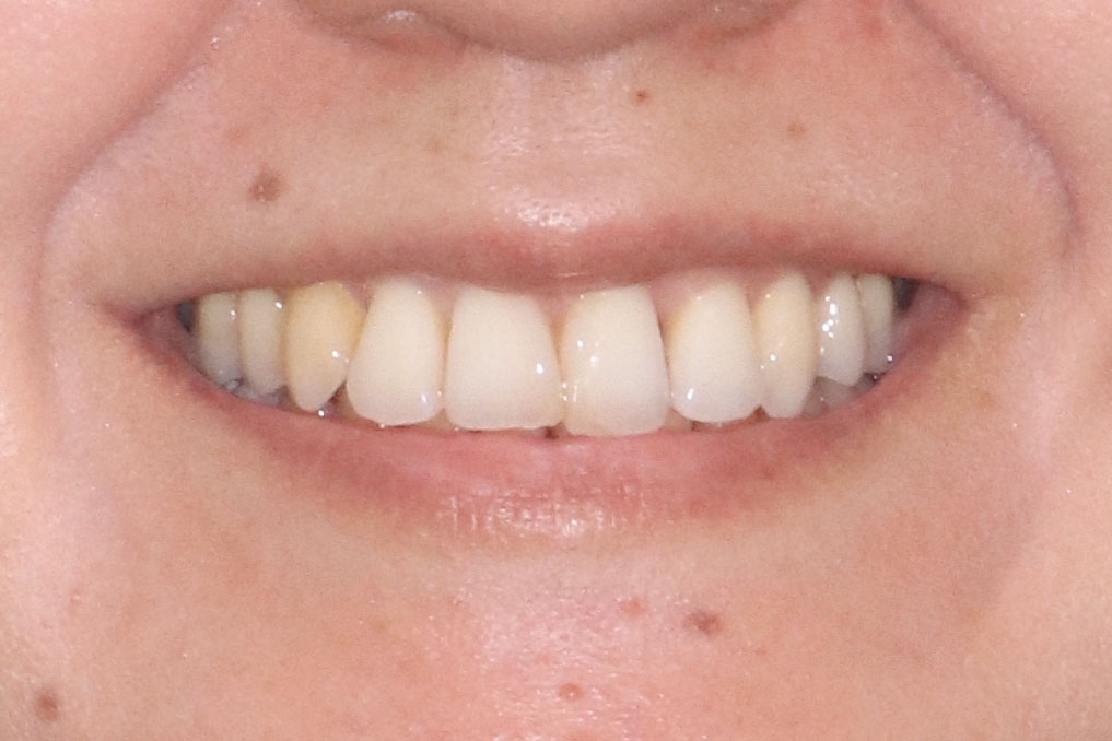30代女性「歯並びが悪い」全顎矯正と治療後のブラックトライアングルをダイレクトボンディングで治療した症例 我孫子の歯医者さん｜なかむら歯科