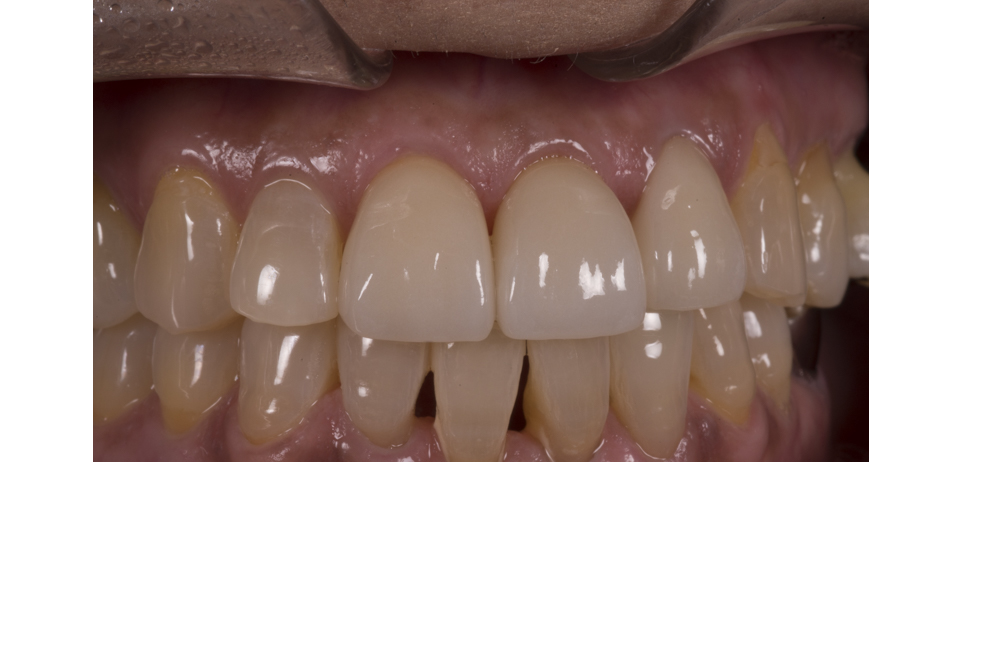 60代女性 歯に隙間ができてきた 重度歯周病治療の症例 我孫子の歯医者さん なかむら歯科