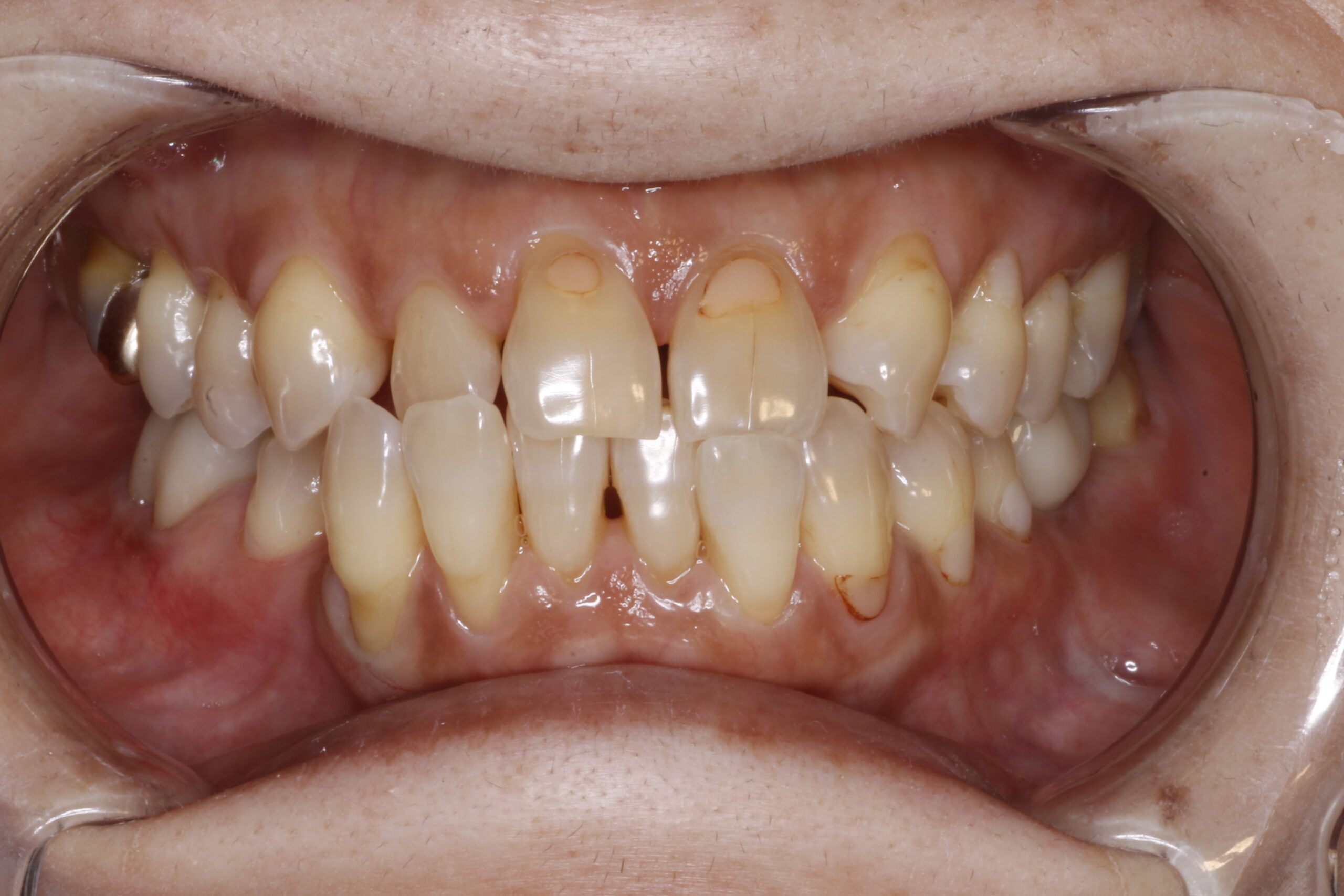 ボロボロ の 歯 治療